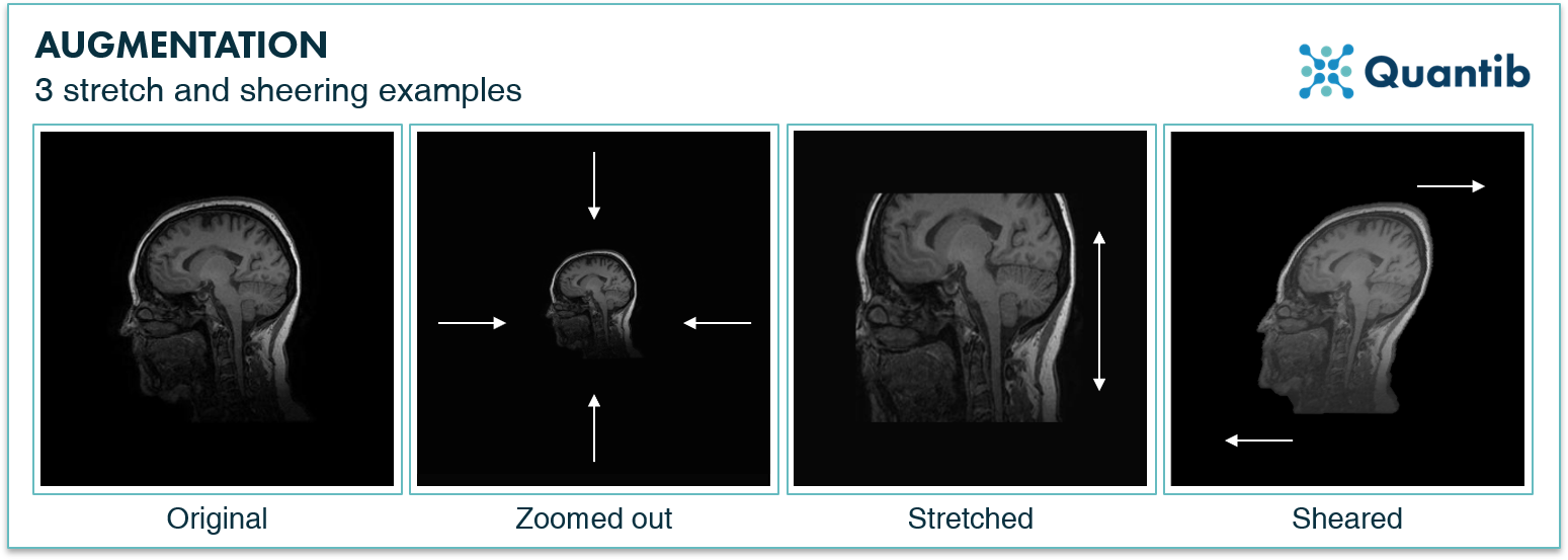 Image augmentation how to small radiology datasets